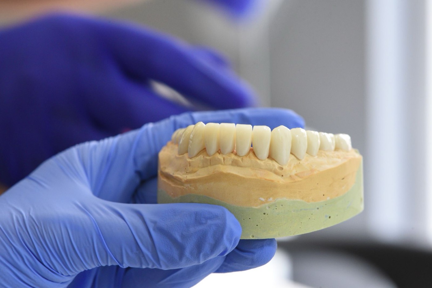 Zahntechnisches Modell für festsitzenden Zahnersatz in Händen mit Handschuhen