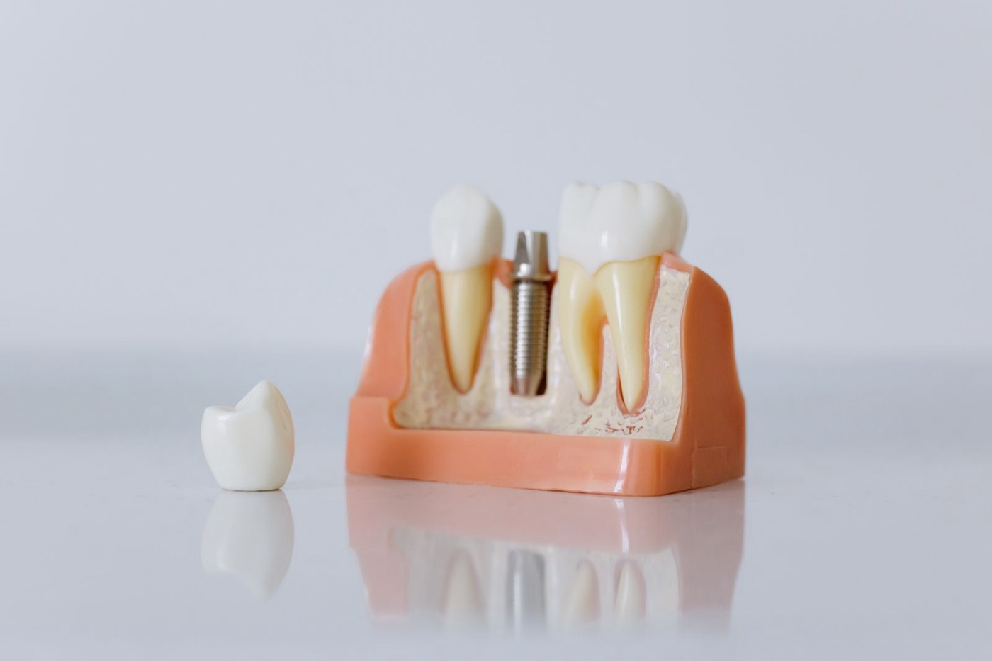 Modell eines implantatgetragenen Zahnersatzes