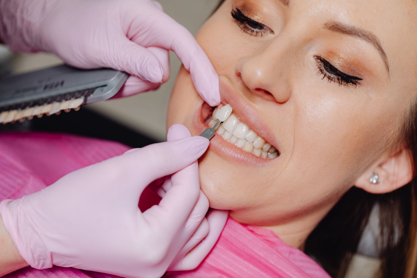 Veneer wird auf Zahn angepasst – Veneers in 1090 Wien